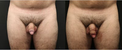 Non-Surgical Phalloplasty Before & After Gallery - Patient 11681850 - Image 1