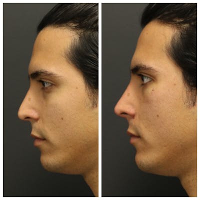 Aesthetic Facial Balancing Before & After Gallery - Patient 11682052 - Image 1