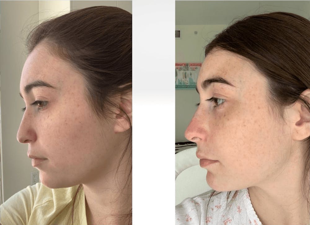 Aesthetic Facial Balancing Before & After Gallery - Patient 11682053 - Image 1