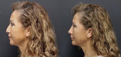 Aesthetic Facial Balancing Before & After Gallery - Patient 11682054 - Image 2