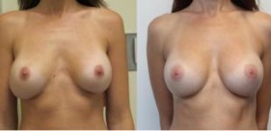 The Maercks Institute Blog | Obstacles to Natural Looking Scarless Transaxillary Results in Breast Augmentation Surgery