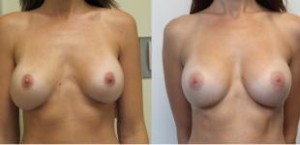 Fake Tits Blog