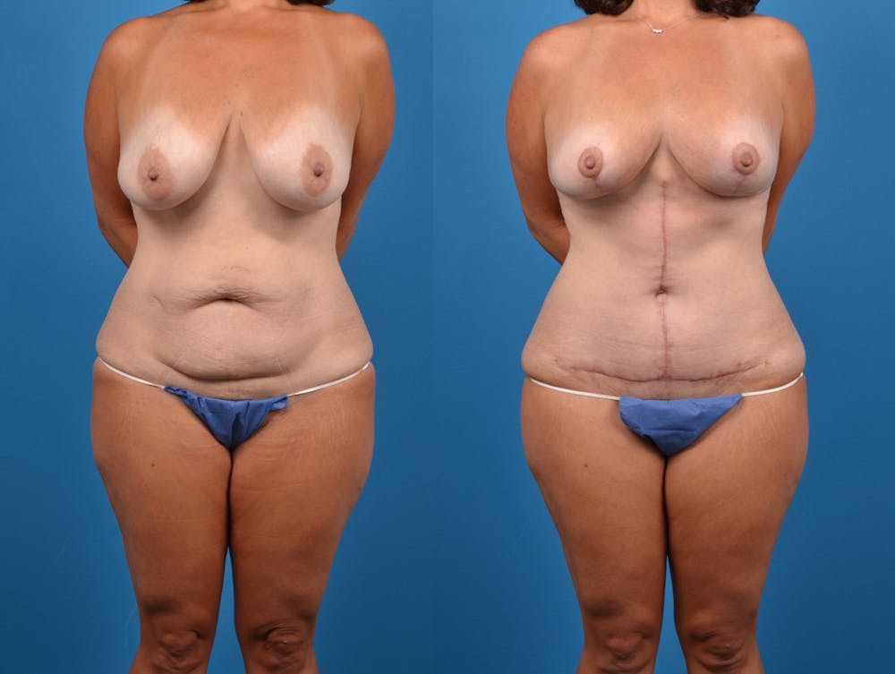 Post-Bariatric Surgery Before & After Gallery - Patient 14779180 - Image 1