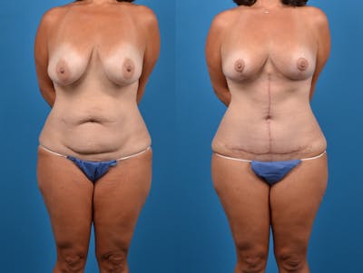 Mommy Makeover Before & After Gallery - Patient 14779178 - Image 1