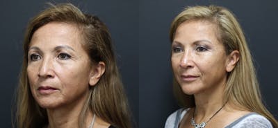 Aesthetic Facial Balancing Before & After Gallery - Patient 11682054 - Image 1