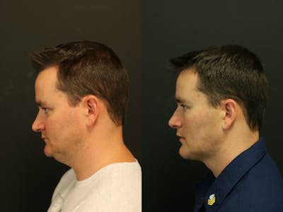 Sliding Genioplasty Before & After Gallery - Patient 14242520 - Image 1