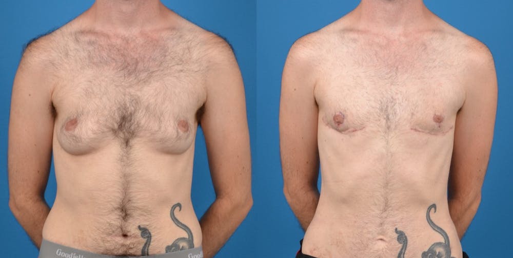 Transgender Surgery (FTM) Before & After Gallery - Patient 14242527 - Image 1