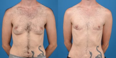Transgender Surgery (FTM) Before & After Gallery - Patient 14242527 - Image 1