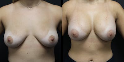 Breast Augmentation Before & After Gallery - Patient 14242461 - Image 1