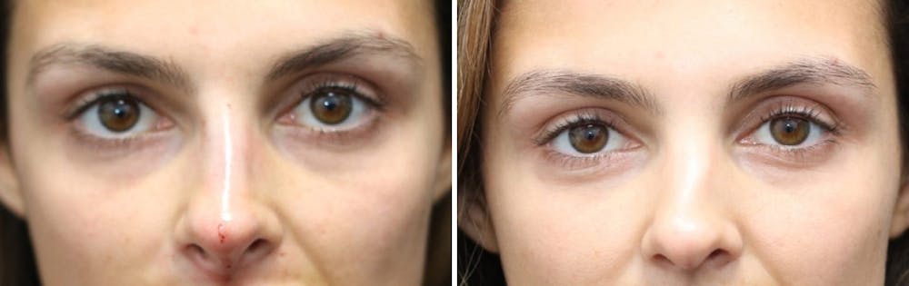Aesthetic Facial Balancing Before & After Gallery - Patient 11681607 - Image 2
