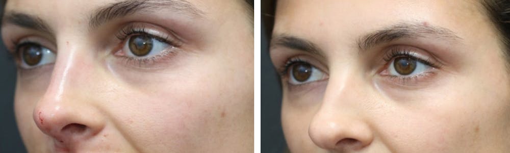 Aesthetic Facial Balancing Before & After Gallery - Patient 11681607 - Image 3