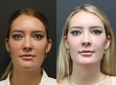 Aesthetic Facial Balancing Before & After Gallery - Patient 11682051 - Image 1