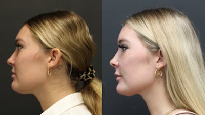 Aesthetic Facial Balancing Before & After Gallery - Patient 11682051 - Image 2