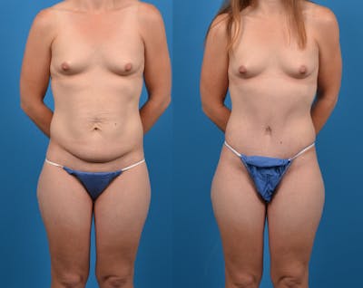 Abdominoplasty Before & After Gallery - Patient 14282482 - Image 1