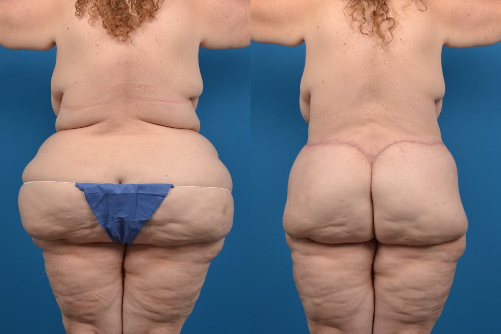 Liposuction Before & After Gallery