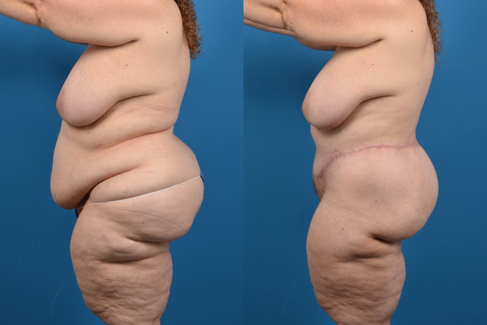 Abdominoplasty Before & After Gallery - Patient 14282484 - Image 1