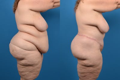 Thigh Lift Before & After Gallery - Patient 14779244 - Image 2