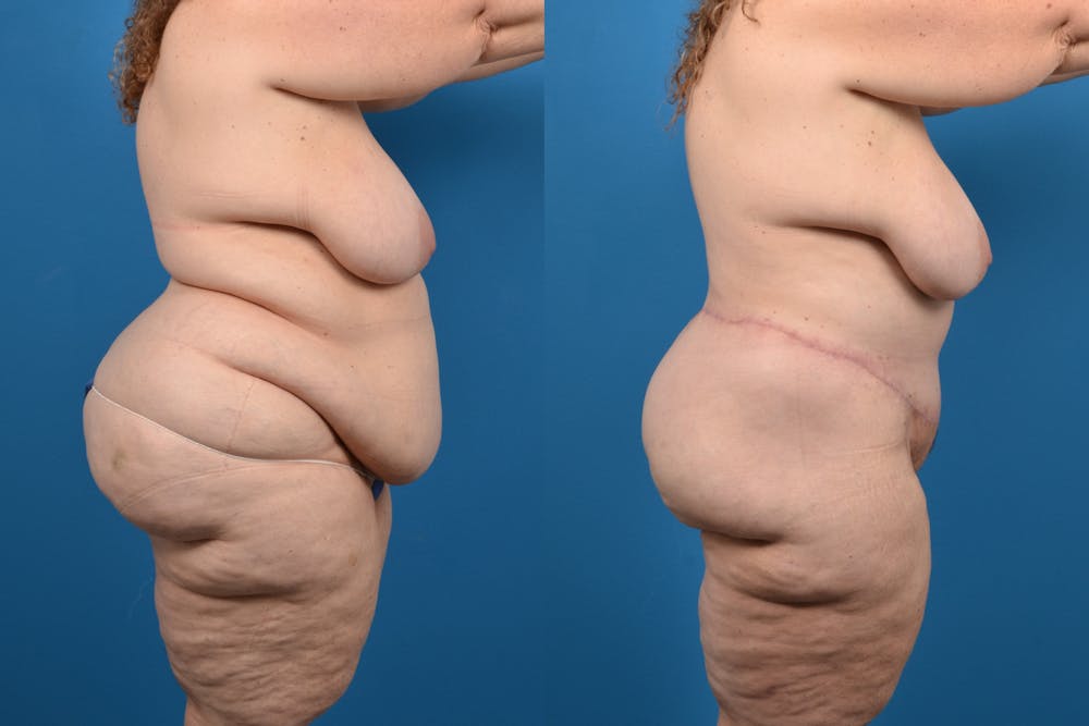 Post-Bariatric Surgery Before & After Gallery - Patient 14779239 - Image 1