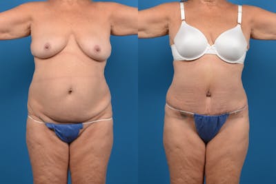 Abdominoplasty Before & After Gallery - Patient 14282492 - Image 1