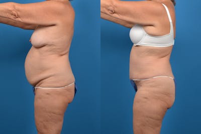 Abdominoplasty Before & After Gallery - Patient 14282492 - Image 2