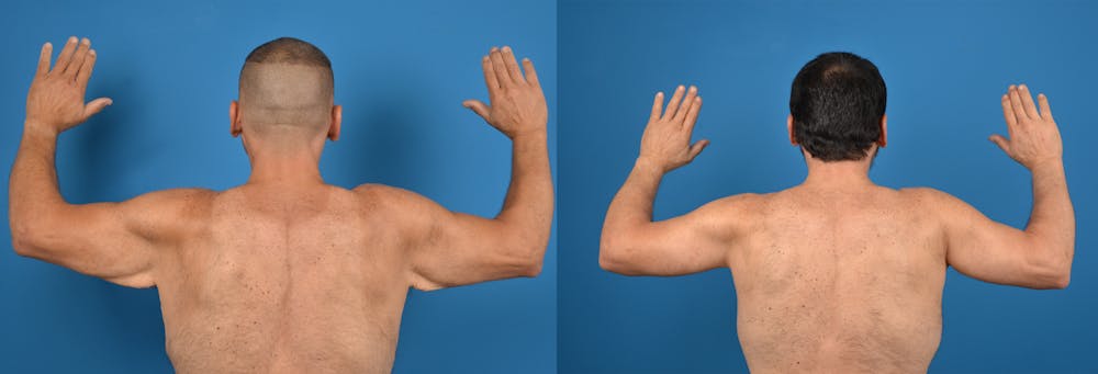 Brachioplasty Before & After Gallery - Patient 14282501 - Image 1