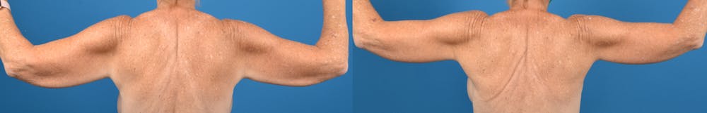 Brachioplasty Before & After Gallery - Patient 14282513 - Image 1