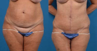 Abdominoplasty Before & After Gallery - Patient 14282518 - Image 1