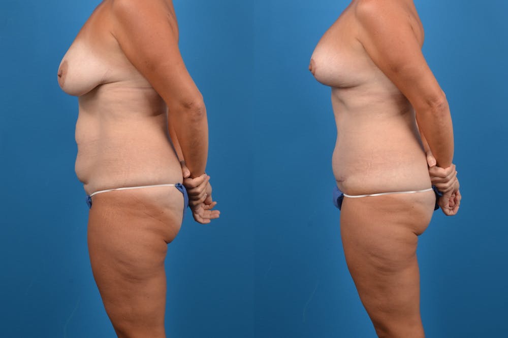 Abdominoplasty Before & After Gallery - Patient 14282519 - Image 2