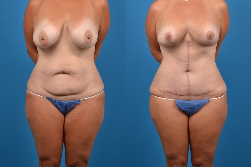 Abdominoplasty Before & After Gallery - Patient 14282519 - Image 1