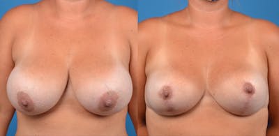 Breast Lift Gallery - Patient 14242475 - Image 1