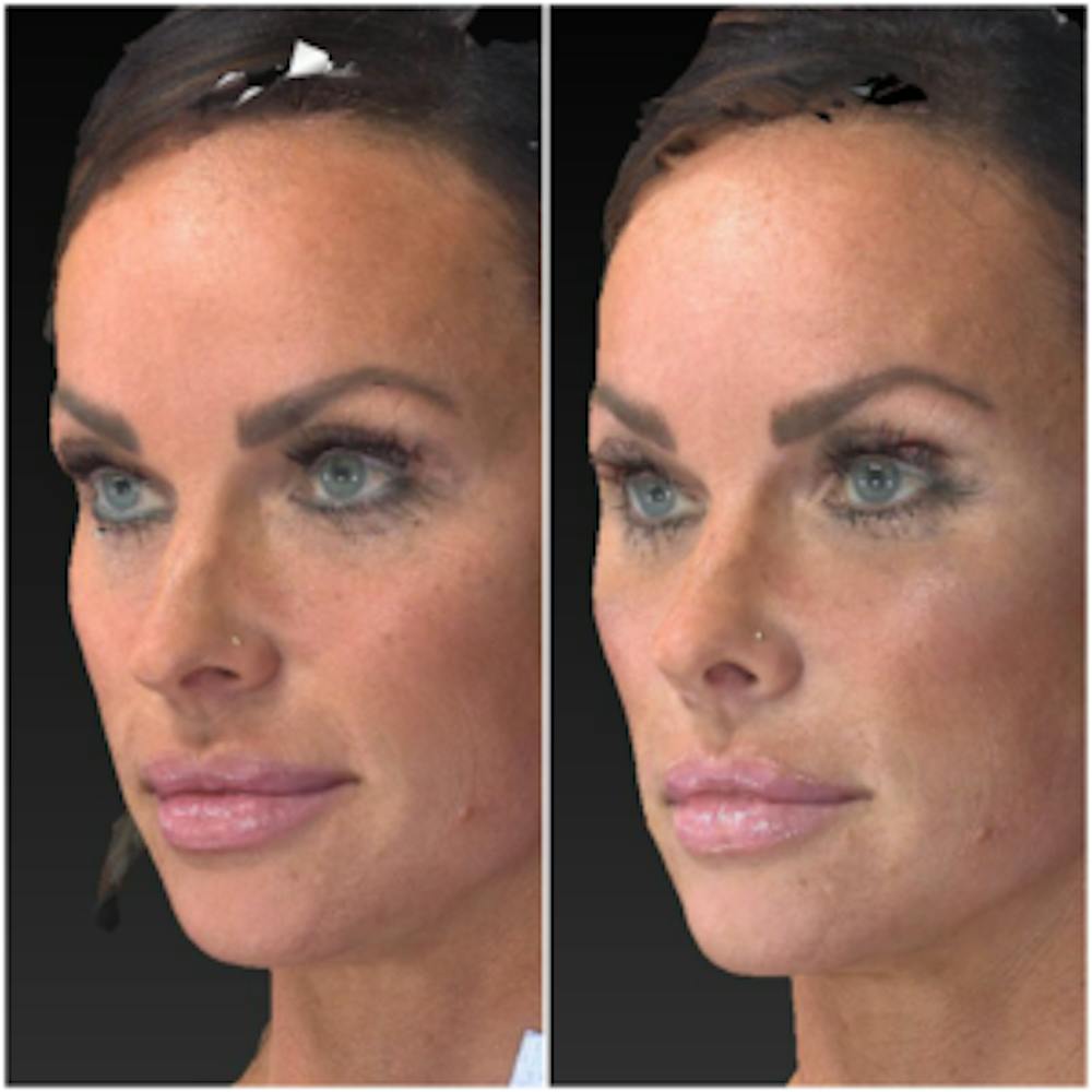 Aesthetic Facial Balancing Before & After Gallery - Patient 14282627 - Image 2
