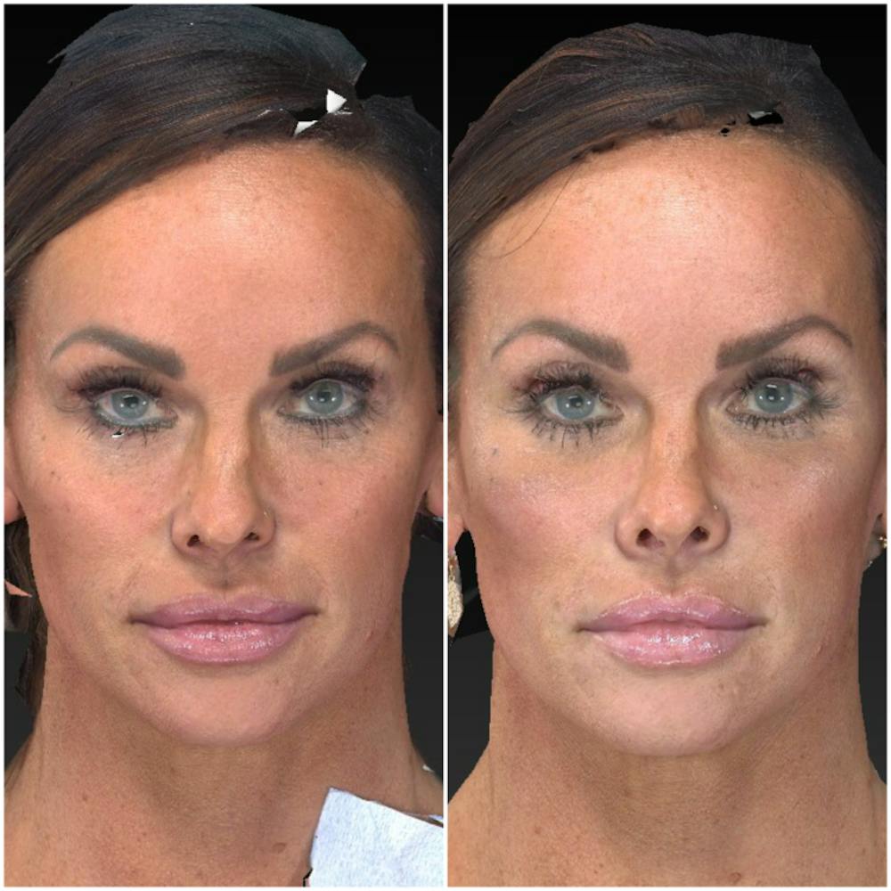 Aesthetic Facial Balancing Before & After Gallery - Patient 14282627 - Image 1