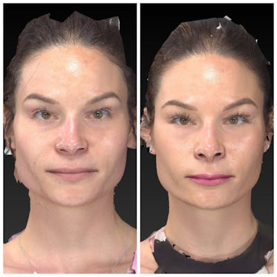 Aesthetic Facial Balancing Gallery - Patient 14282628 - Image 1