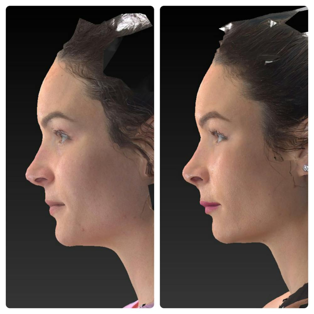 Aesthetic Facial Balancing Before & After Gallery - Patient 14282628 - Image 3