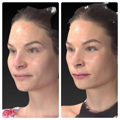 Aesthetic Facial Balancing Before & After Gallery - Patient 14282628 - Image 2