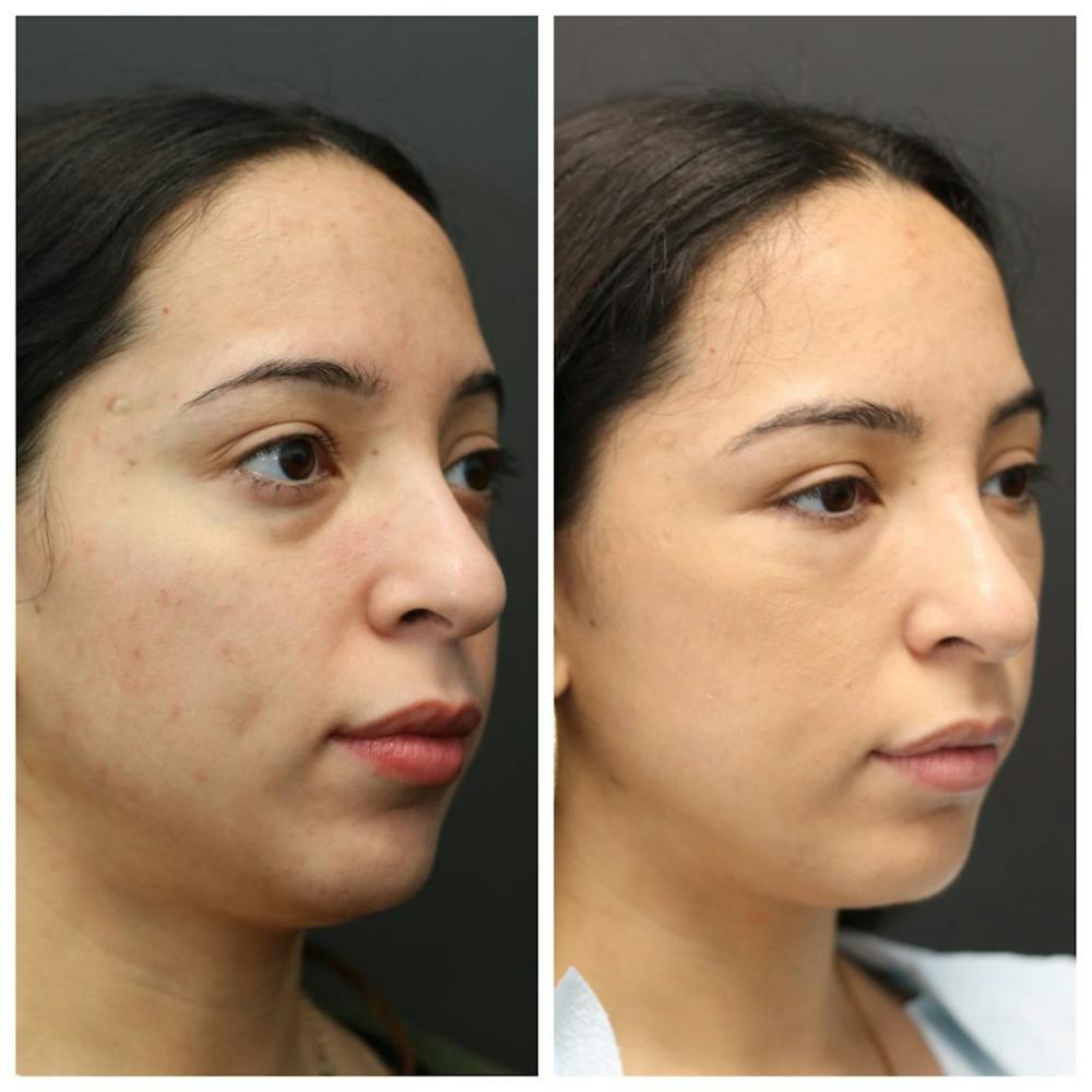 Aesthetic Facial Balancing Before & After Gallery - Patient 14282629 - Image 2