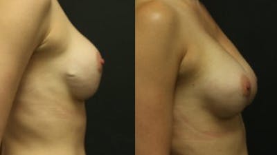 Breast Revision Before & After Gallery - Patient 11681813 - Image 2