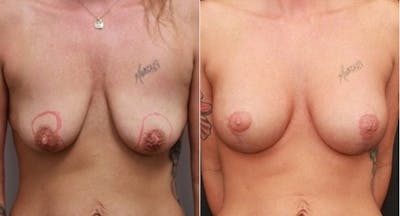Breast Lift Before & After Gallery - Patient 11681795 - Image 1