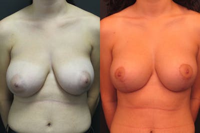 Breast Lift Before & After Gallery - Patient 11681804 - Image 1