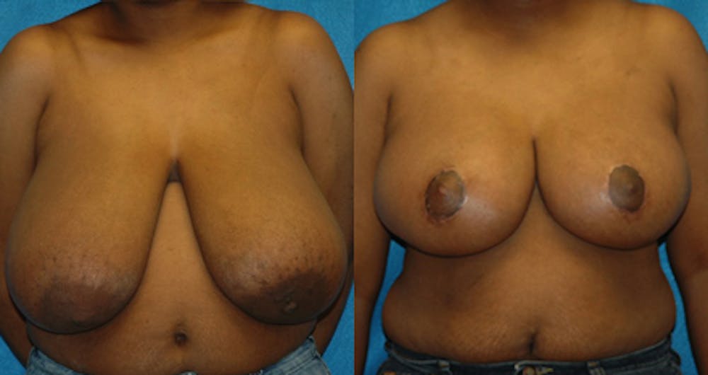 Breast Lift Before & After Gallery - Patient 11681805 - Image 1