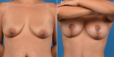 Breast Lift Gallery - Patient 11681987 - Image 1
