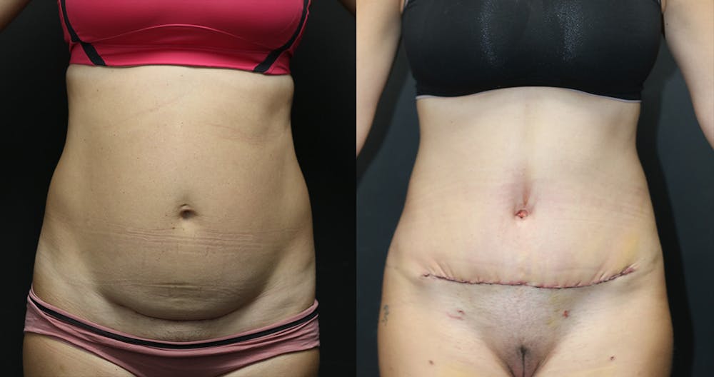 Abdominoplasty Before & After Gallery - Patient 14391441 - Image 1