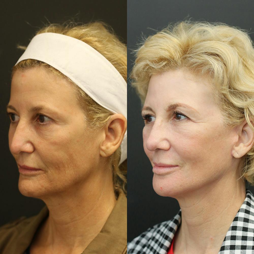 Facelift Before & After Gallery - Patient 14390174 - Image 1