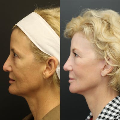 Facelift Before & After Gallery - Patient 14390174 - Image 2