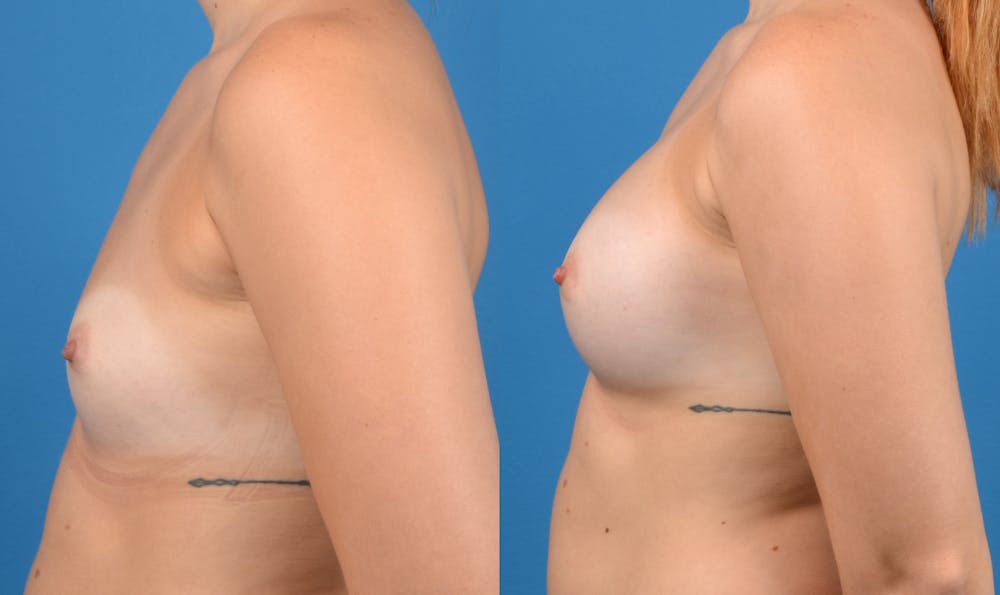 Breast Augmentation Gallery - Patient 14242463 - Image 2