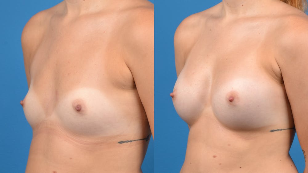 Breast Augmentation Before & After Gallery - Patient 14242463 - Image 3