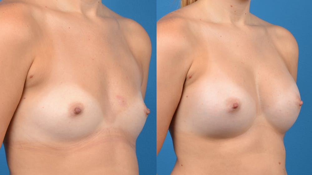 Breast Augmentation Gallery - Patient 14242463 - Image 4