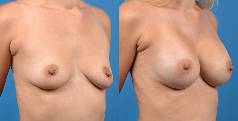 Breast Augmentation Gallery - Patient 14242464 - Image 2