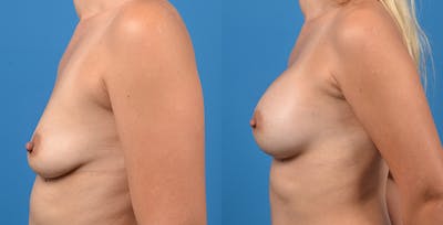 Breast Augmentation Before & After Gallery - Patient 14242464 - Image 4