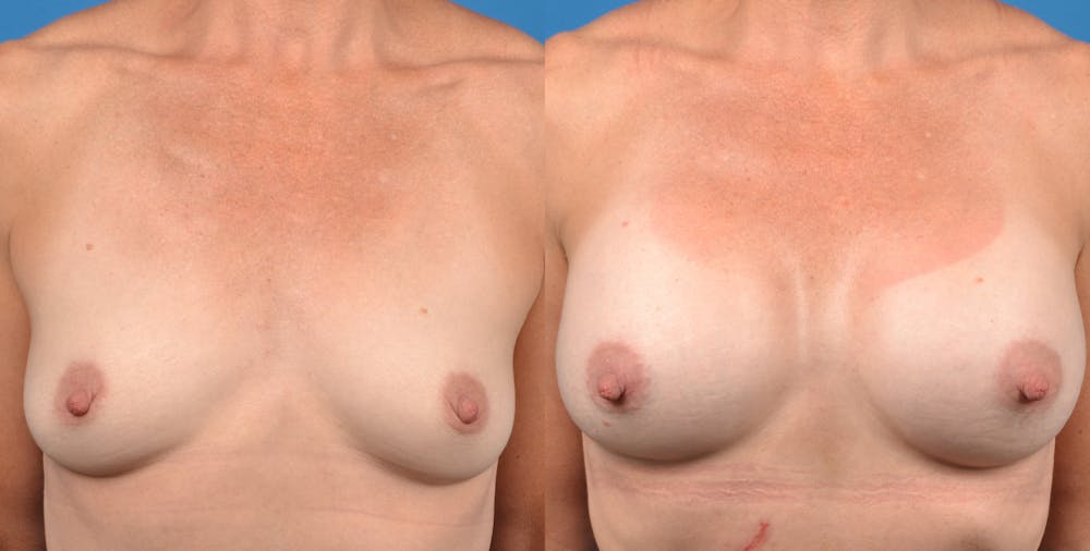 Breast Augmentation Gallery - Patient 14778322 - Image 1